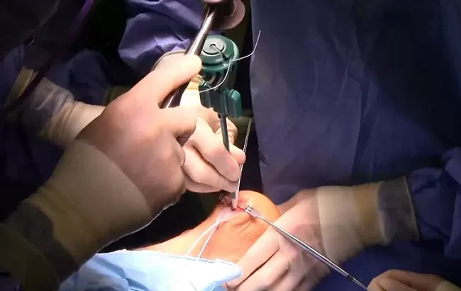 Thốn gót chân là bệnh gì? Cách trị thốn gót chân 1 mo gai got chan.png