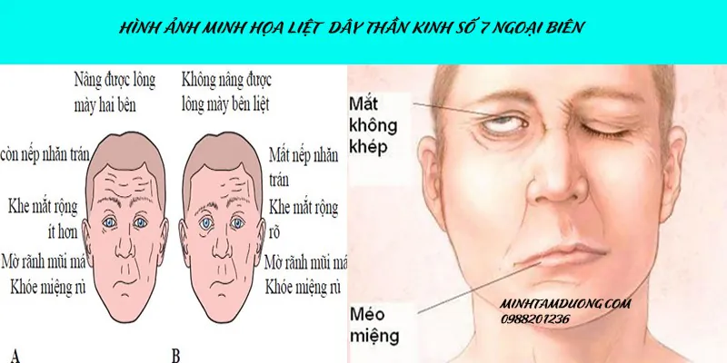 Tìm hiểu về liệt dây thần kinh Số 7 và những điều cần biết để phòng tránh 1 Hình ảnh minh họa của bệnh liệt dây thần kinh số 7