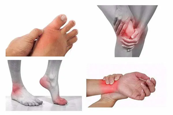 Cách phòng ngừa các bệnh lý xương khớp thường gặp vào mùa mưa 3 Ảnh minh họa bệnh Gout