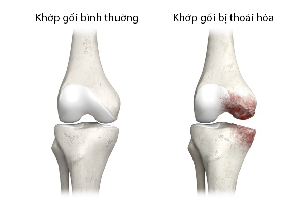 thoai hoa khop goi 1