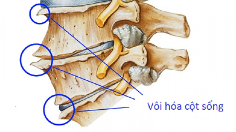 Vôi hóa cột sống: Nguyên nhân, triệu chứng và điều trị bằng vật lý trị liệu 1 voi hoa cot song la gi