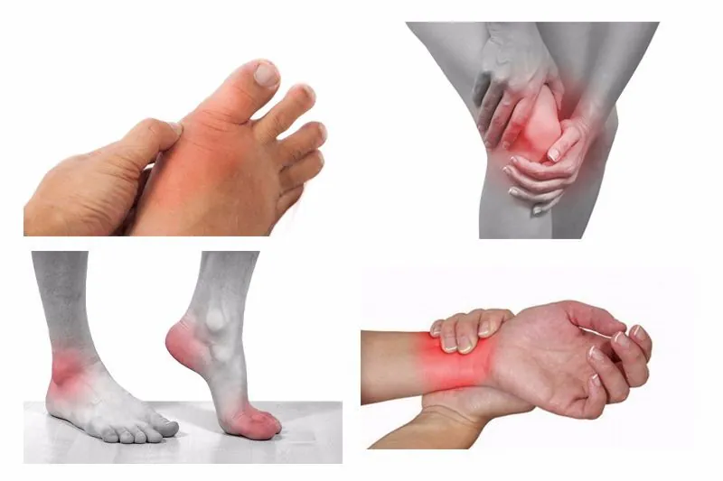 Viêm khớp dạng nhiễm khuẩn: Điều trị kịp thời để tránh biến chứng 2 Các triệu chứng của viêm khớp dạng nhiễm khuẩn thường xuất hiện đột ngột và trở nên nghiêm trọng nhanh chón