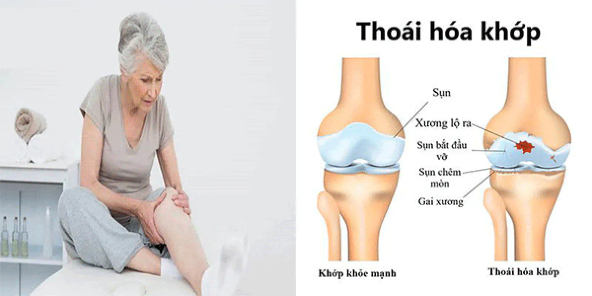 Phương pháp vật lý trị liệu giúp ngăn ngừa thoái hóa khớp ở người cao tuổi 2 Các bài tập nhẹ nhàng và các phương pháp trị liệu như xoa bóp giúp tăng cường tuần hoàn máu, cung cấp dưỡng chất cần thiết cho khớp và làm chậm quá trình thoái hóa