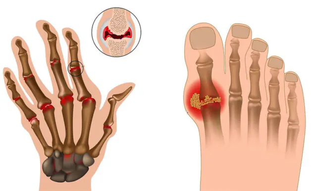 Viêm khớp dạng nhiễm khuẩn: Điều trị kịp thời để tránh biến chứng 1 Viêm khớp dạng nhiễm khuẩn, còn gọi là viêm khớp mủ, là tình trạng viêm khớp do vi khuẩn, virus, hoặc nấm xâm nhập vào khớp gây ra.