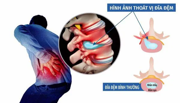 Thoát vị đĩa đệm có điều trị dứt điểm được không? 1 41