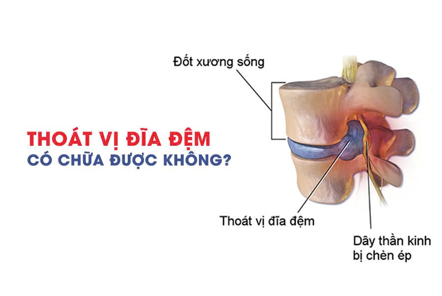 Chữa thoát vị đĩa đệm Cần Thơ - Y khoa Thái Dương 4 Chữa thoát vị đĩa đệm Cần Thơ - Y khoa Thái Dương