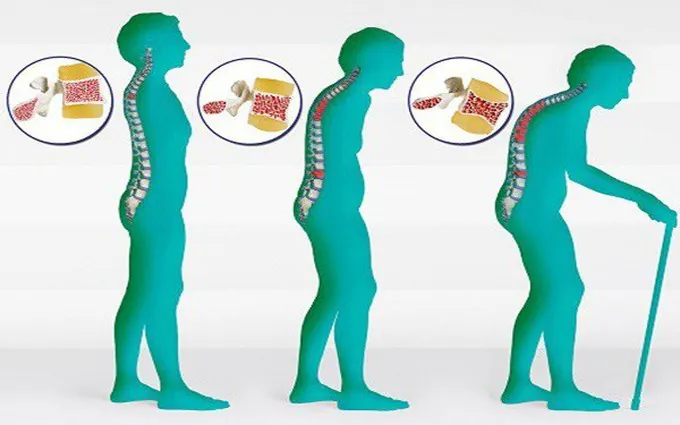 Những lưu ý quan trọng trong phòng ngừa loãng xương 2 phòng ngừa loãng xương