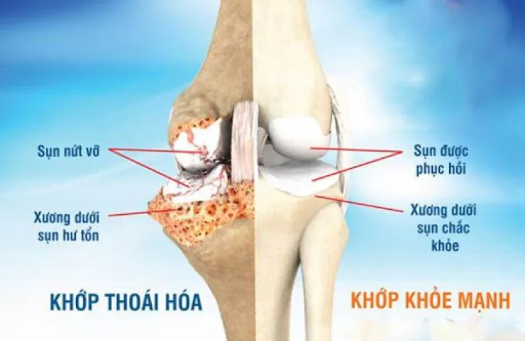 Thoái hóa khớp gối có nguy hiểm không? Hướng dẫn điều trị từ bác sĩ tại phòng khám Y Khoa Thái Dương 2 Thoái hóa khớp gối có nguy hiểm không