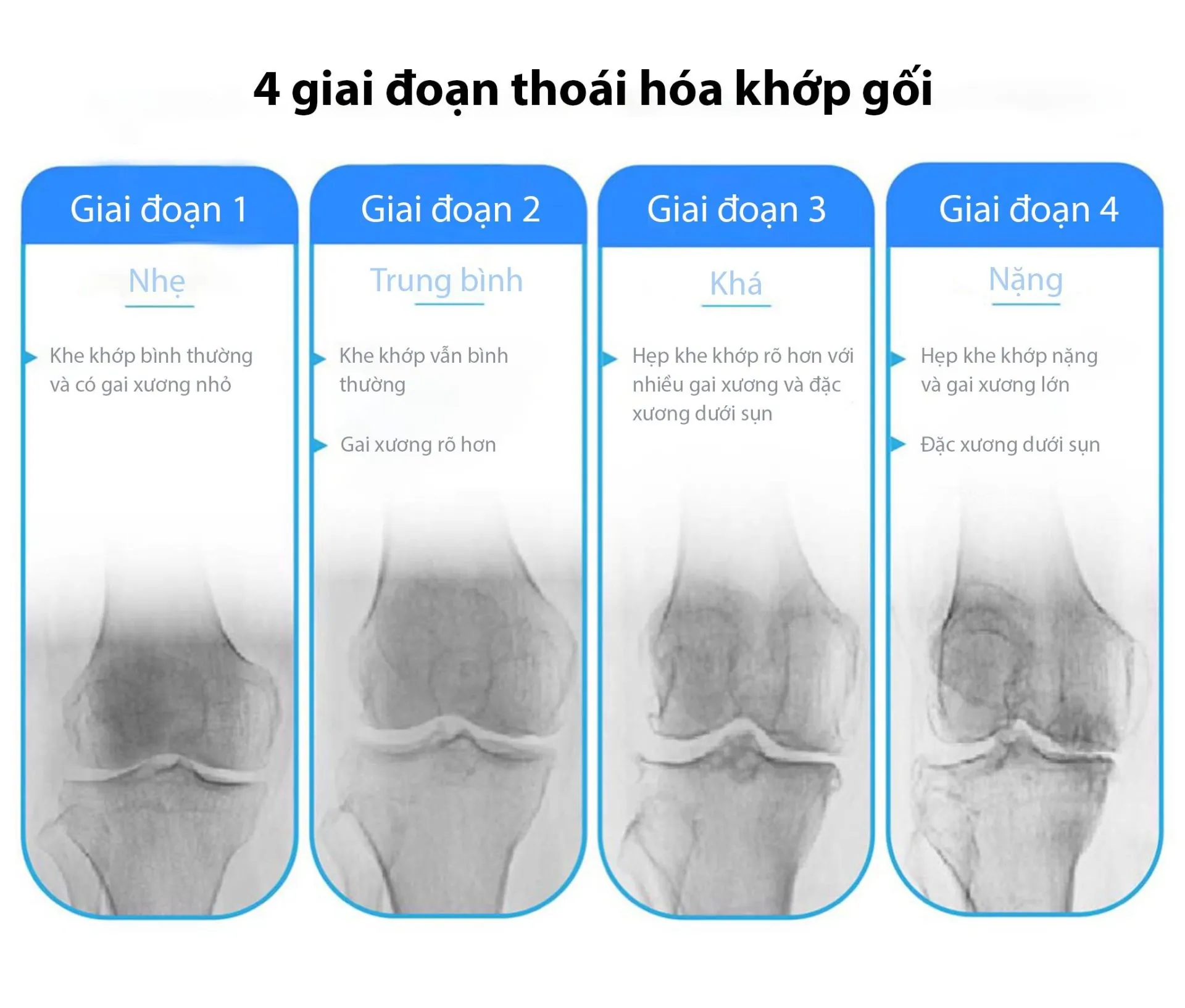 Thoái hóa khớp gối có nguy hiểm không? Hướng dẫn điều trị từ bác sĩ tại phòng khám Y Khoa Thái Dương 3 Thoái hóa khớp gối có nguy hiểm không