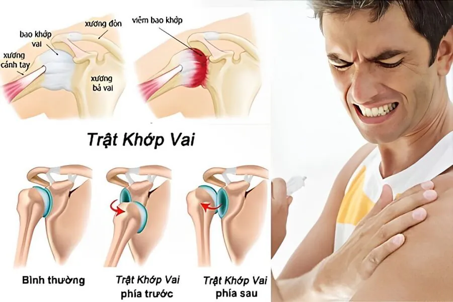 Trật Khớp Vai Khám Ở Đâu Cần Thơ? Điều Trị An Toàn 1 Trật Khớp Vai Khám Ở Đâu Cần Thơ