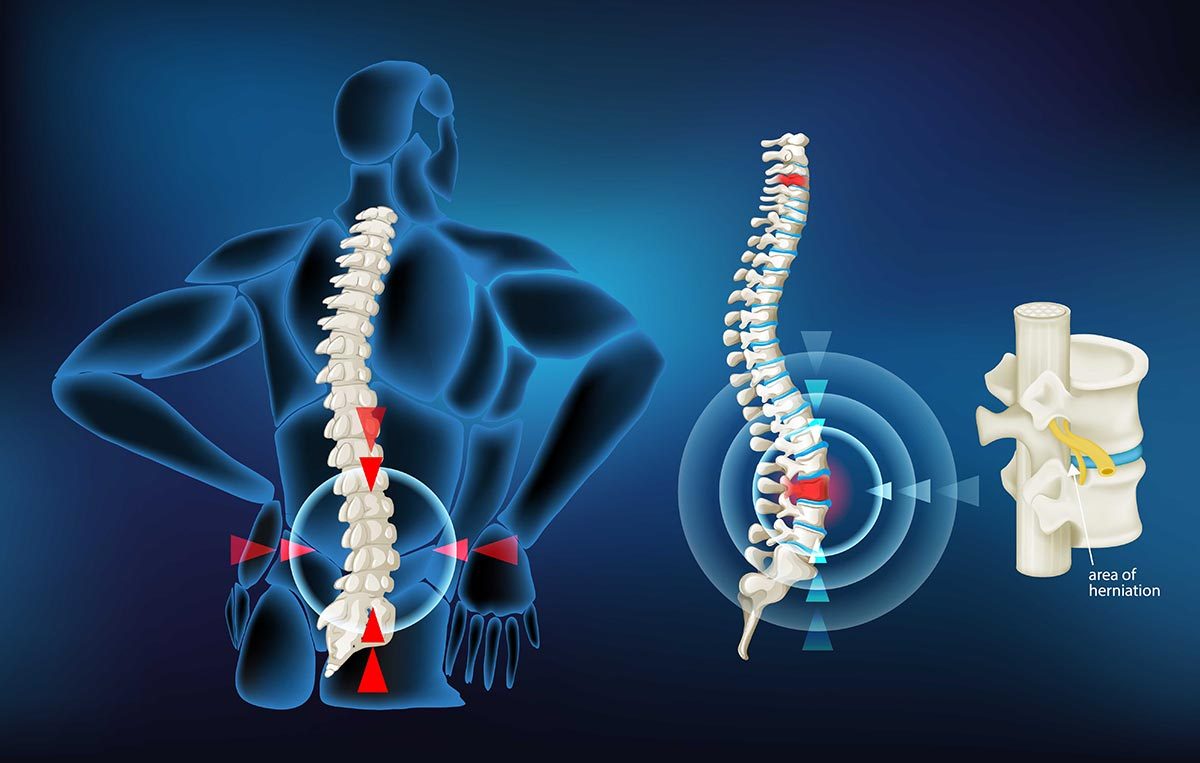 Chữa thoát vị đĩa đệm Cần Thơ - Y khoa Thái Dương 2 Chữa thoát vị đĩa đệm Cần Thơ - Y khoa Thái Dương